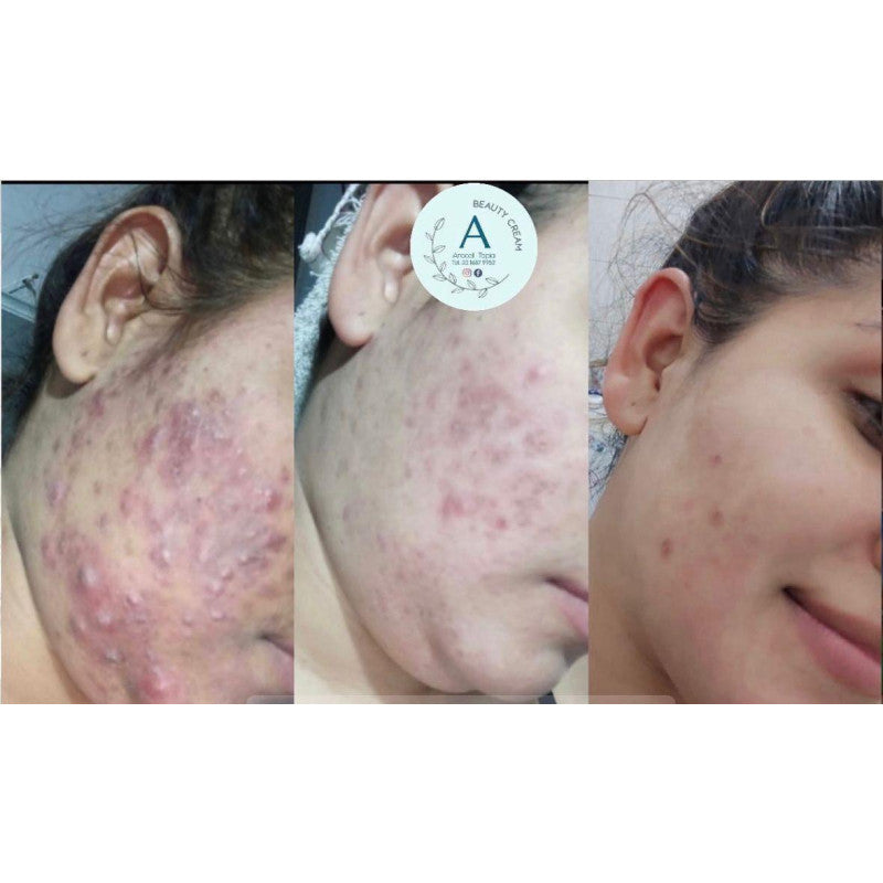 Crema beauty cream acne